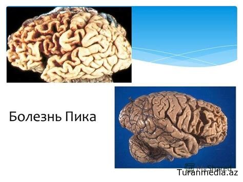 Прорыв в изучении болезни Пика: генетические исследования Mayo Clinic открывают новые горизонты